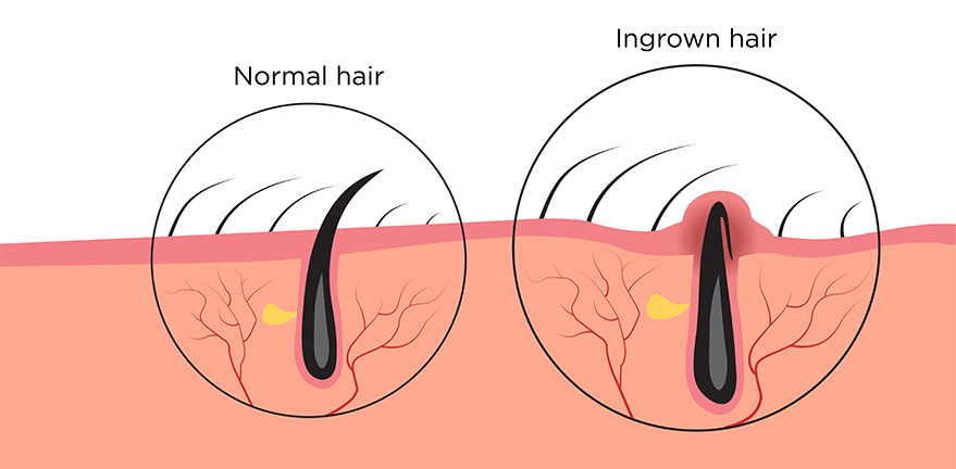 Normal & Ingrown Hair